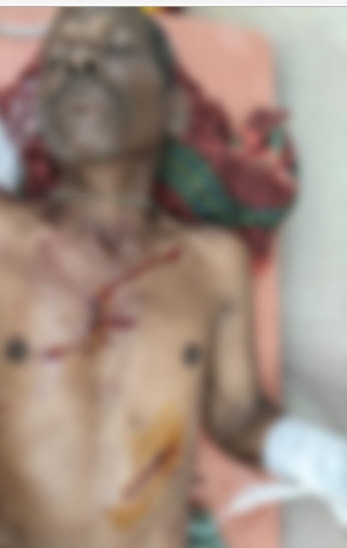 महुआ बीनने जंगल गए दो लोगों पर भालू का जानलेवा हमला